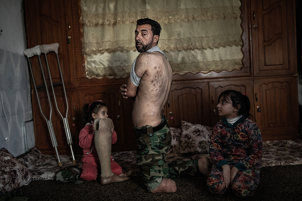 Photo of a Kurdish man and his two daughers in their home. The man has shrapnel scars and one leg amputated; one of the daughters holds his prosthesis.